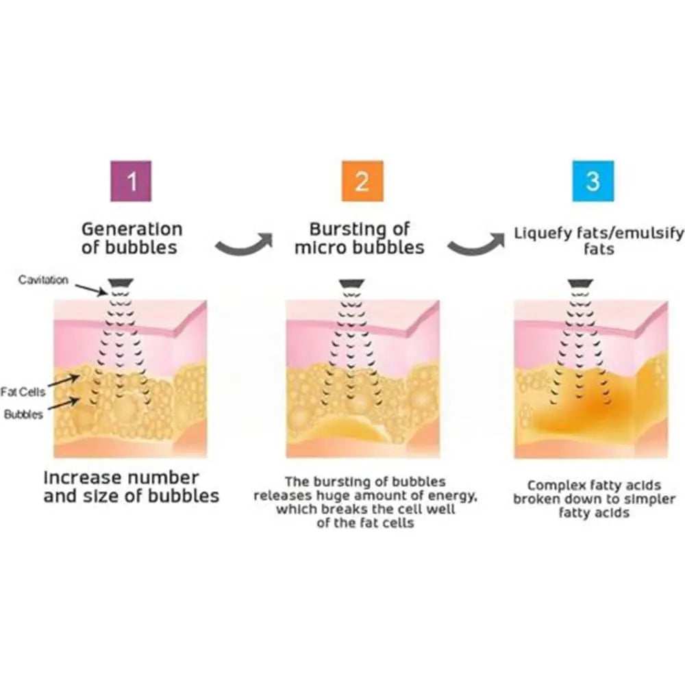 Matt- Ultrasonic Body Shape Wristband